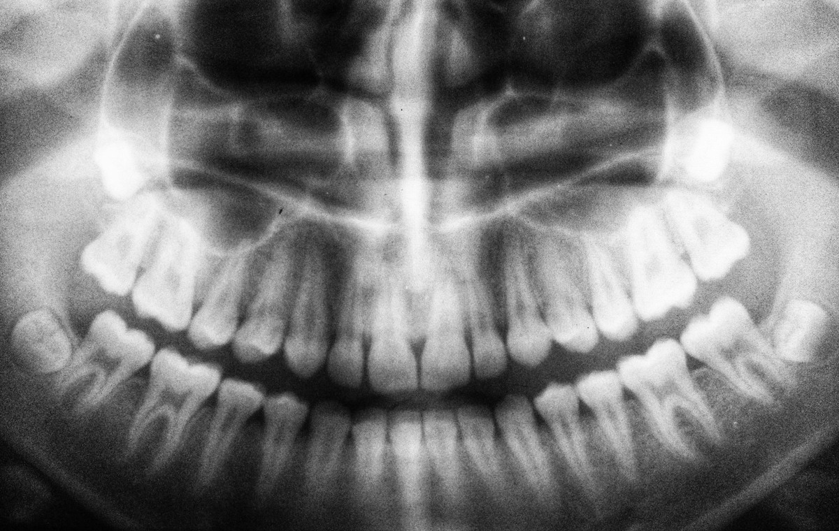 teeth X-ray